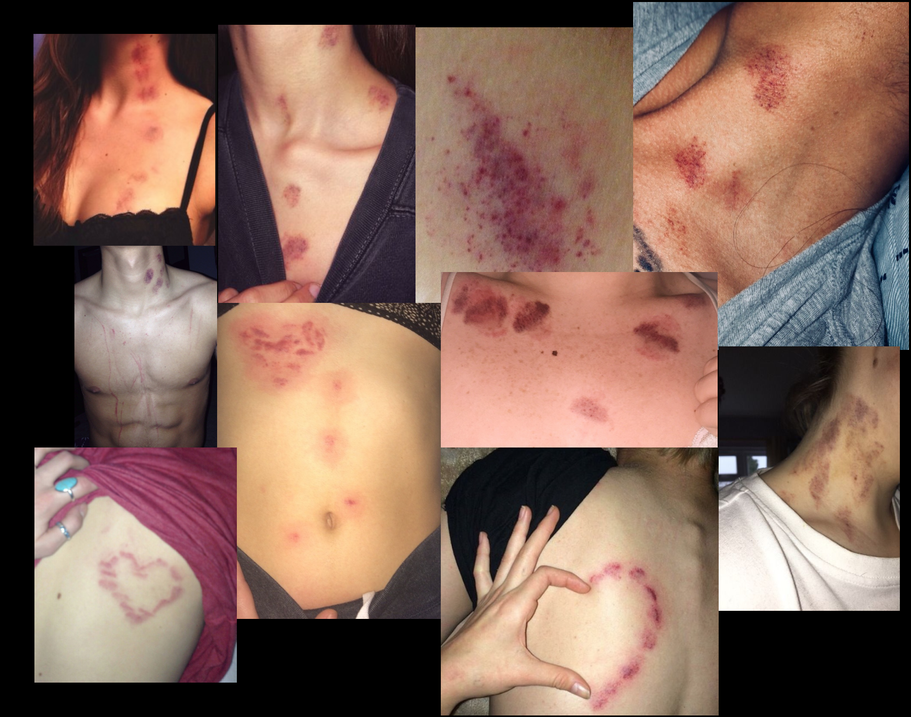people online showing off their hickies