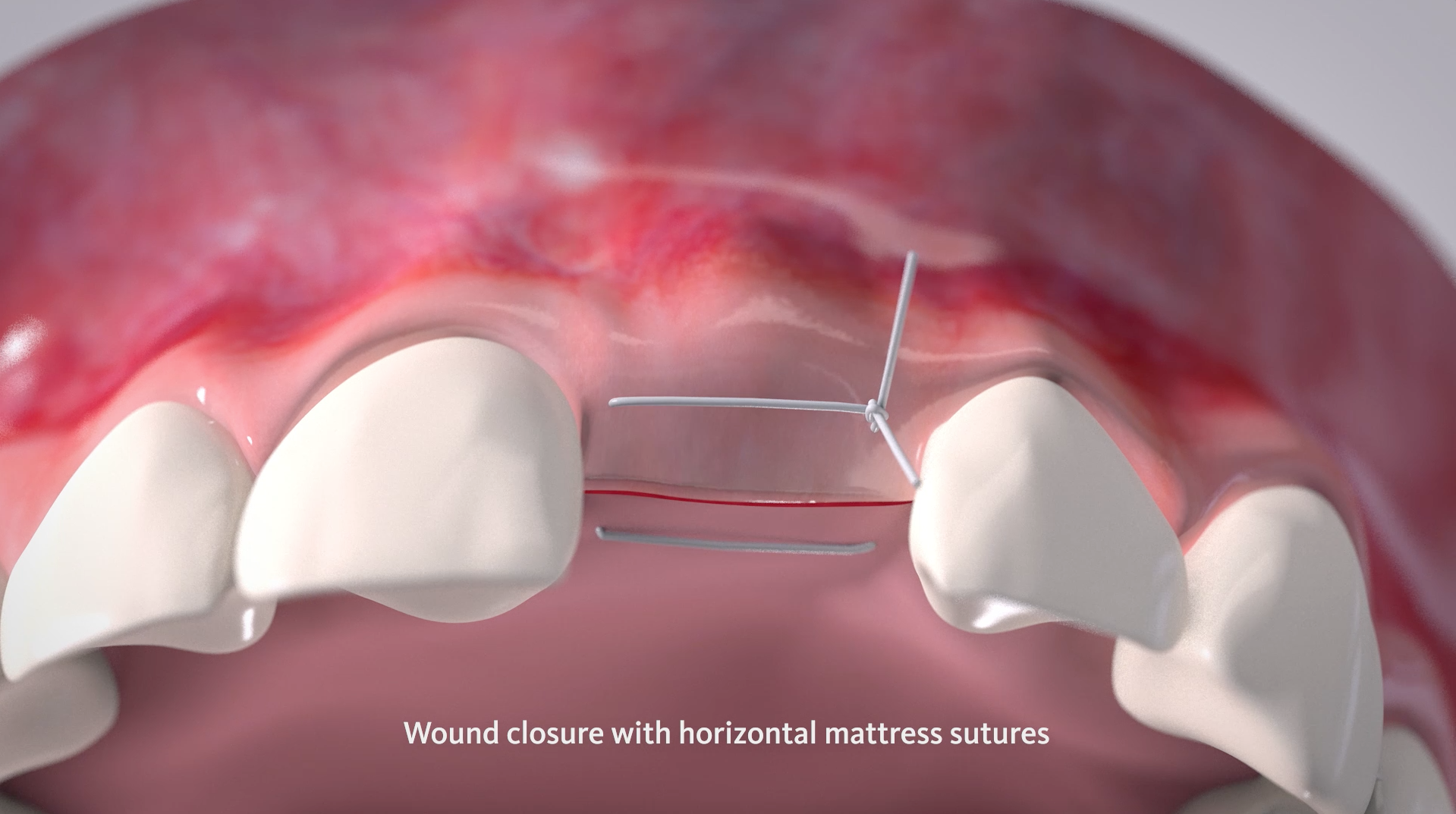 Suturing of the soft tissue.