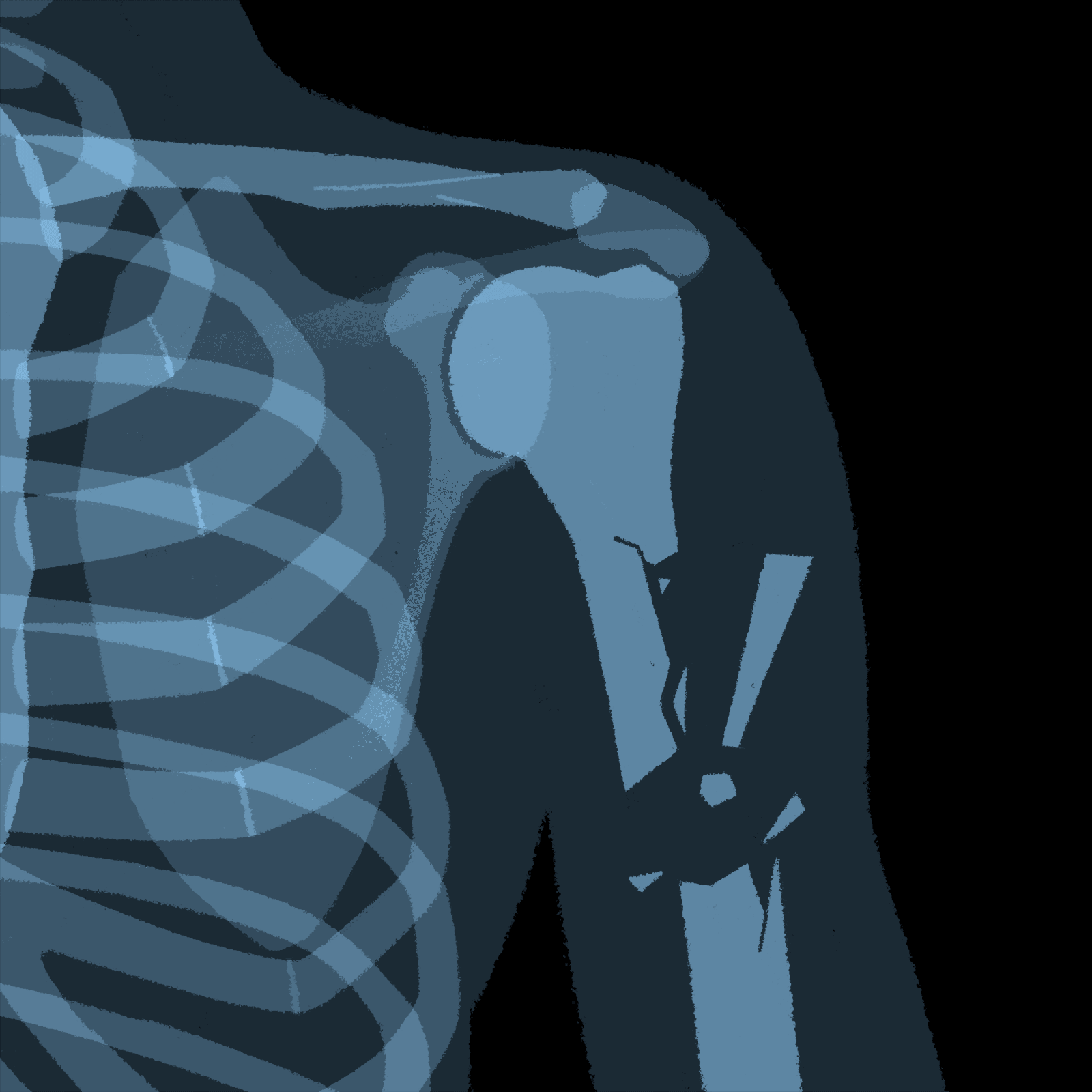 Broken Bones