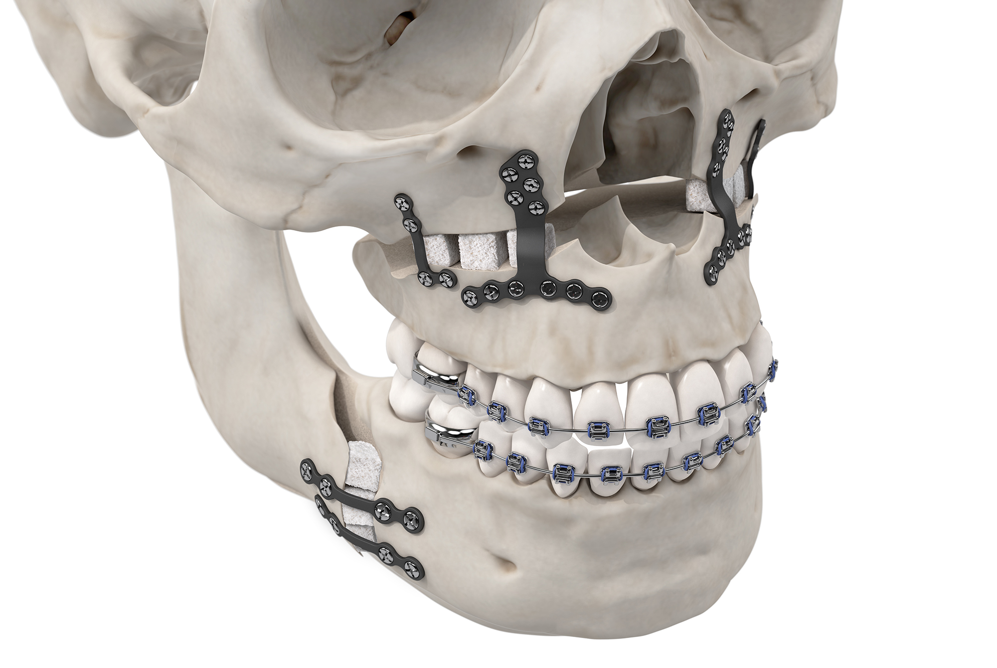 Showcasing different methods of bone augmentation.