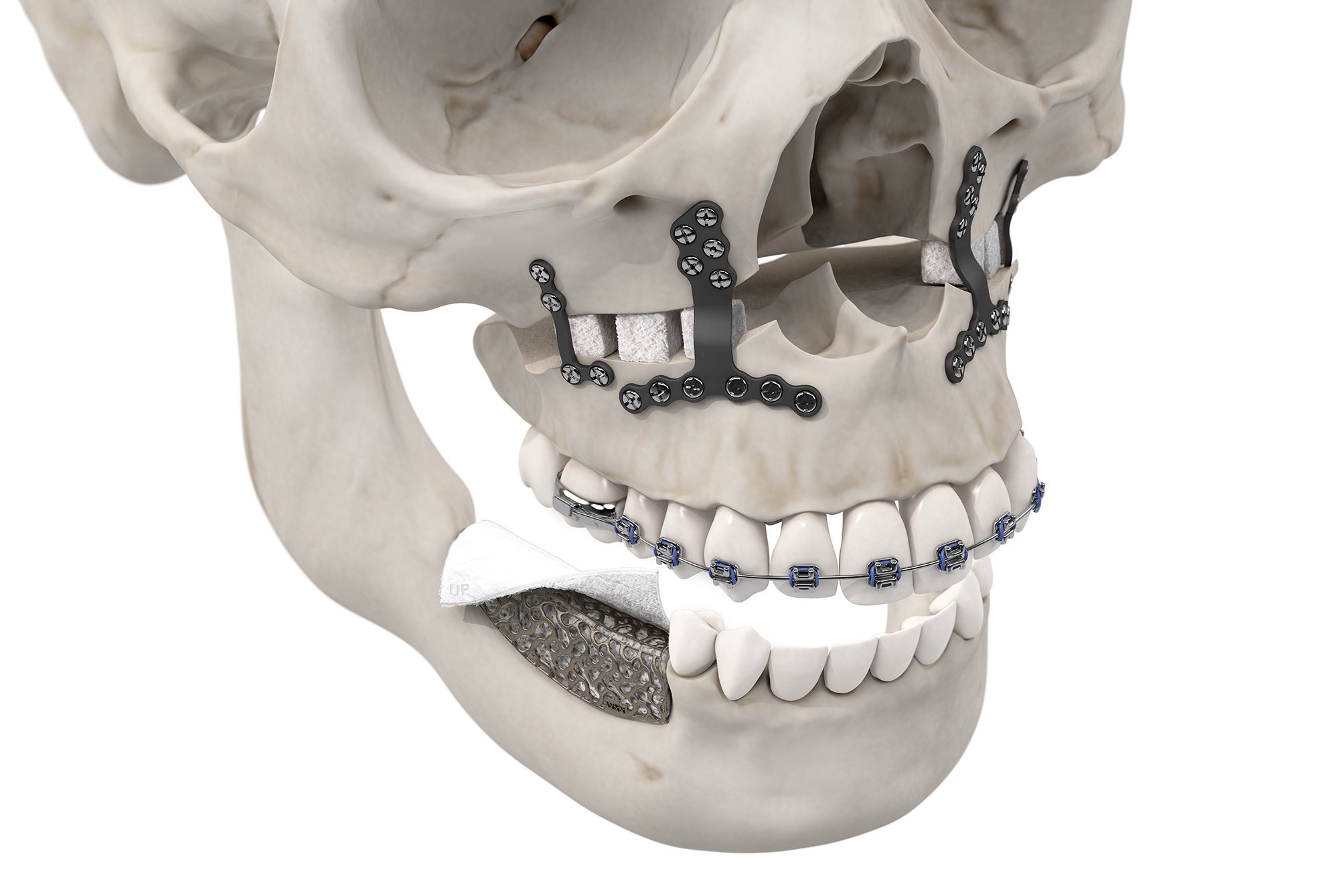 Showcasing different methods of bone augmentation.