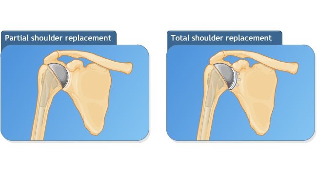 Types of shoulder replacement