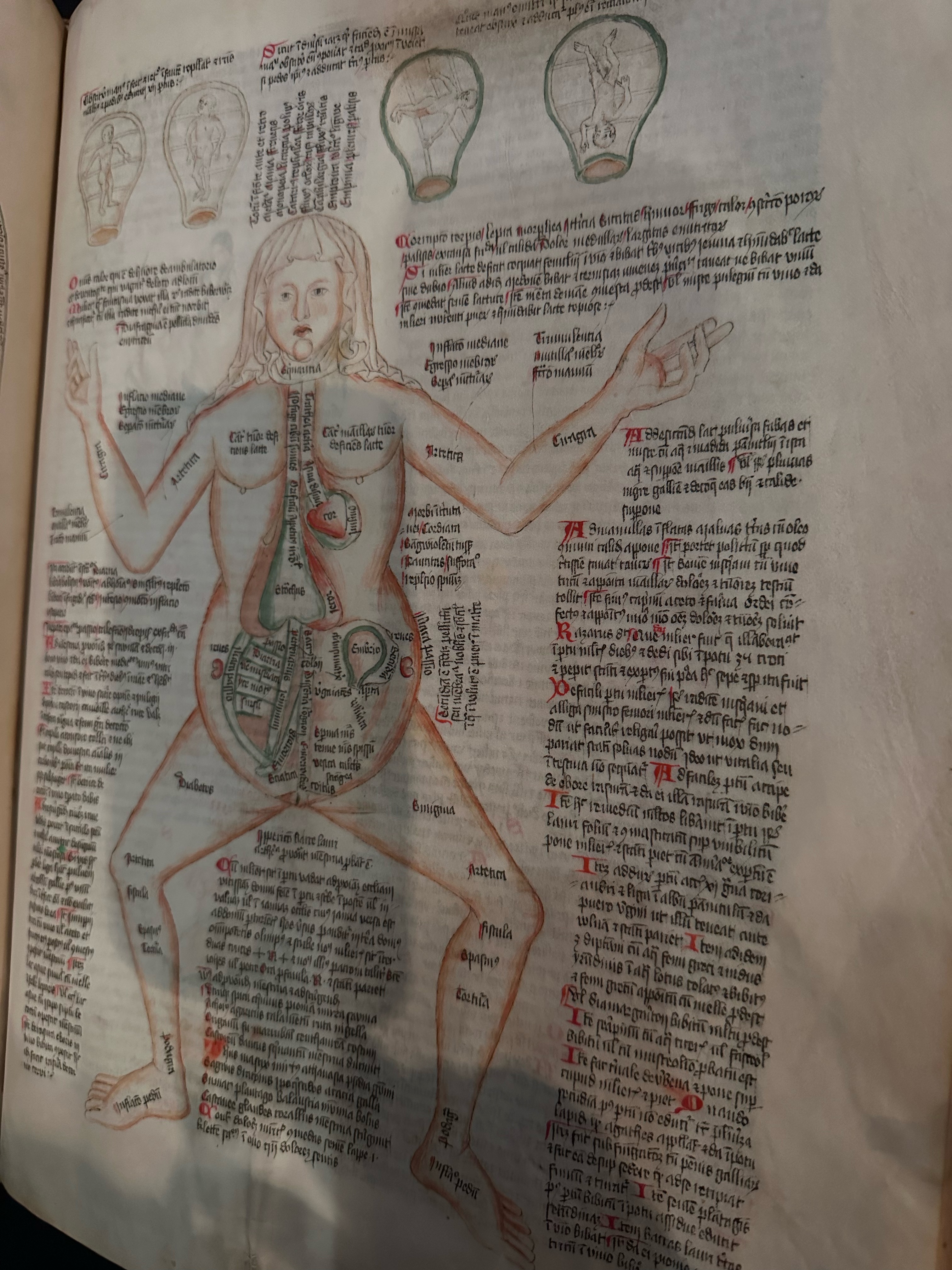 ︎︎︎ Material from Wellcome Collection, London, named 'Disease Woman', around 1420 from Germany. Most medieval and early modern medical diagrams depict the male figure and anatomy – this is still the case today, as such with defibrillators in public areas intended for a member of the public to use in the event of cardiac arrest – the models are seen without breasts, therefore the defibrillator is used differently on male and female bodies. Women are statistically twice as likely to die from a heart attack than men. Of course, the male figure on the manuals in defibrillators are not the only reason for this, as women are 4 times more likely than men to be prescribed with anti-anxiety medication for the heart attack they are actually having. Relating back to the image, although this depiction of ‘Disease Women’ was intended as a basic teaching guide, the diaphragm reinforces the incorrect idea of the female body as inherently predisposed to disease and therefore faulty. When we think about medicine and access to healthcare, most people expect it as a science to be impartial and to be fair. However the history of medicine, as well as being a scientific history, is one that is deeply linked to social and cultural issues; one that has always been rooted in the oppression of marginalised groups. We live in patriarchal societies and male dominance is ingrained in medicine and research continues to reflect it, affecting the medical knowledge that we have today.