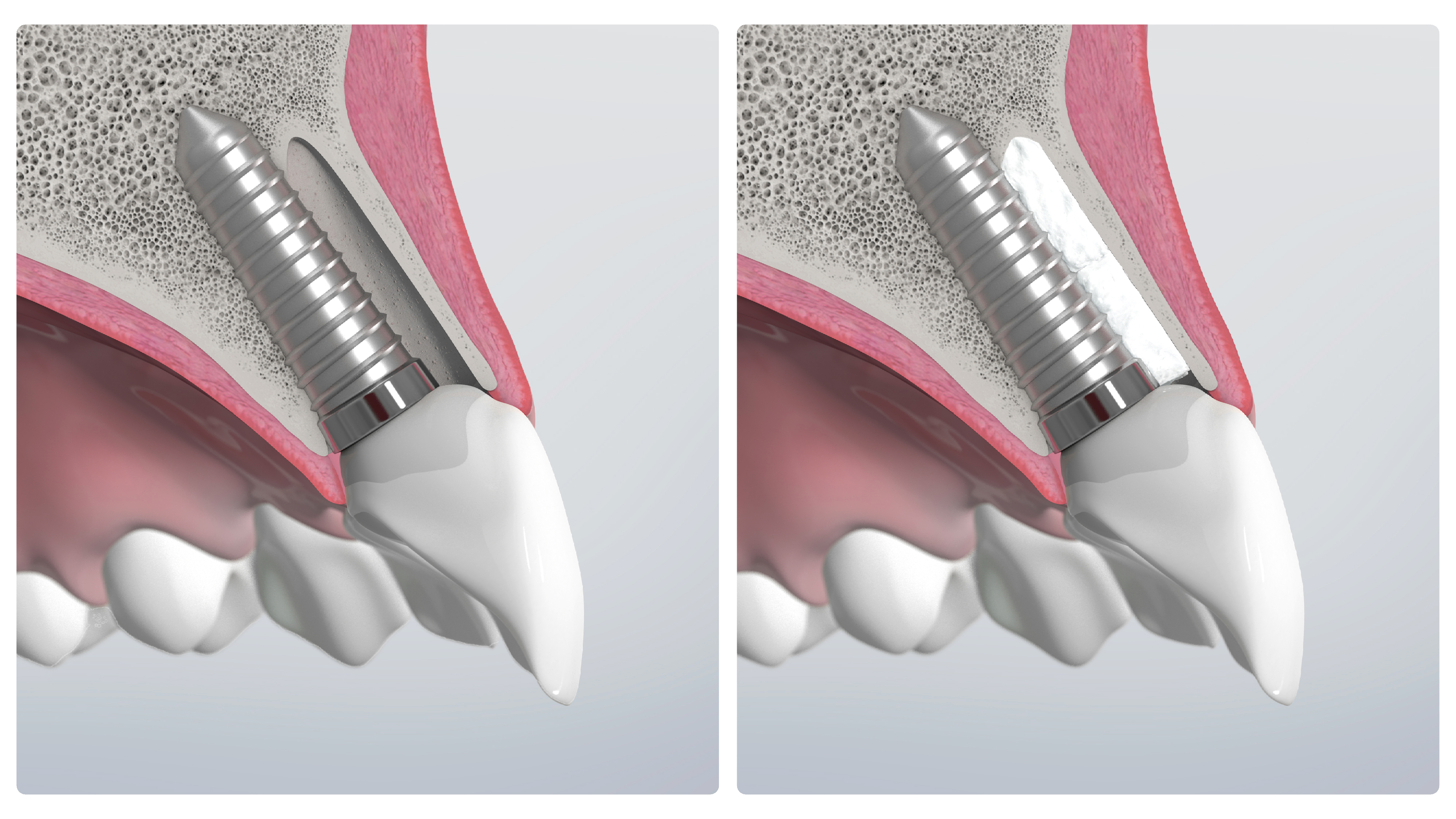 Before and after healing – without and with a biomaterial used to preserve bone.