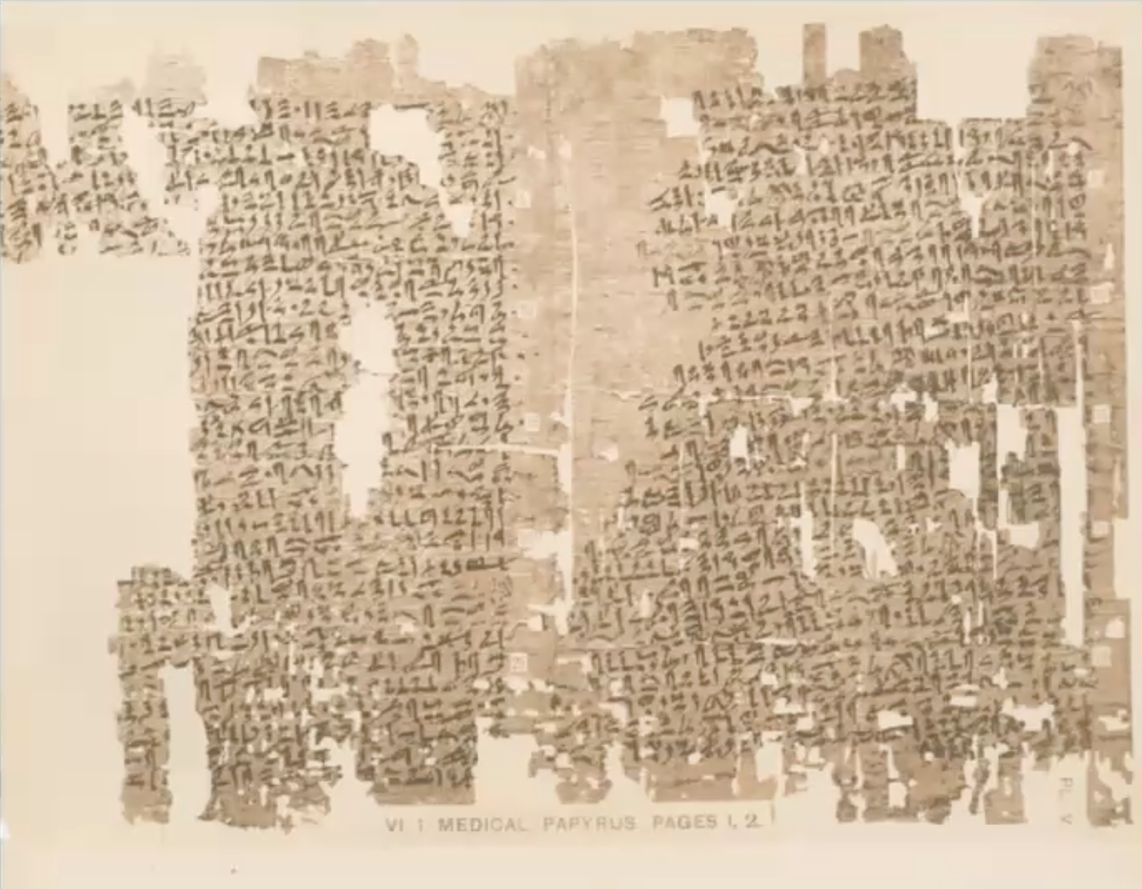 ︎︎︎ 1825 BCE Egyptian text ‘Kahun Gynaecological Papyrus’. Endometriosis was first named in 1920, but symptoms of endometriosis have been documented in medical literature since this text in 1825 BCE. The symptoms here were really pathologised as being physical expressions of emotional distress, rather than actual physical symptoms; something that radiated throughout the European Witch hunts and into the 19th century of the times of female hysteria diagnoses. This was a time where Women, complaining of pain and symptoms of endometriosis, were treated by being accused of being ‘hysteric’ or mad. These Women were admitted to asylums and/or had to have very aggressive surgeries including removal of ovaries, hysterectomy and even lobotomies. The cases of hysterectomies is actually still being used, wrongly, in treating endometriosis. In Leah Hazard's book titled ‘Womb’, Leah writes that by point of surgery, often the person with endometriosis will have stage 3 or 4 before finally being taken seriously and referred for surgery. I say a ‘wrongful treatment of hysterectomy' here in cases when the endometriosis lesions have already spread, attaching itself to other organs, including outside of the pelvic cavity. These lesions go on to grow and further spread, so removal of any of the reproductive organs is redundant. In reflection of the rhetorics of hysteria, I think this feeling about Women and it being more psychological rather than an actual physical cause, persists today. As we see so Women are often frequently dismissed as being ‘neurotic’, anxious or a hypochondriac when they first mention their first symptoms of endometriosis. On average, 8 years later, she might be finally diagnosed. Doctors and those around them will tell them “this is an inevitable consequence of being female”. Prior to paying for private healthcare for my own diagnosis of endometriosis in 2023, I was told to “have a baby”. That this would “cure” my endometriosis – there is no evidence suggesting in any way that this is true, but I did look back in history to find where this falsification originated. It was Dr. Joe Meage, who was and still is a very influential American gynaecologist. He held a public lecture in the 1940s, where he announced that endometriosis was a disease "mainly seen in white, wealthy women who delay marriage and childbearing due to having careers." This idea of lack of childbearing in Women causing endometriosis echoes that of the Hippocratic Corpus, which was a text written around 1,500 years earlier between 5th and 3rd centuries BCE. I’m particularly interested in the trajectory of medical treatises into present day myths.