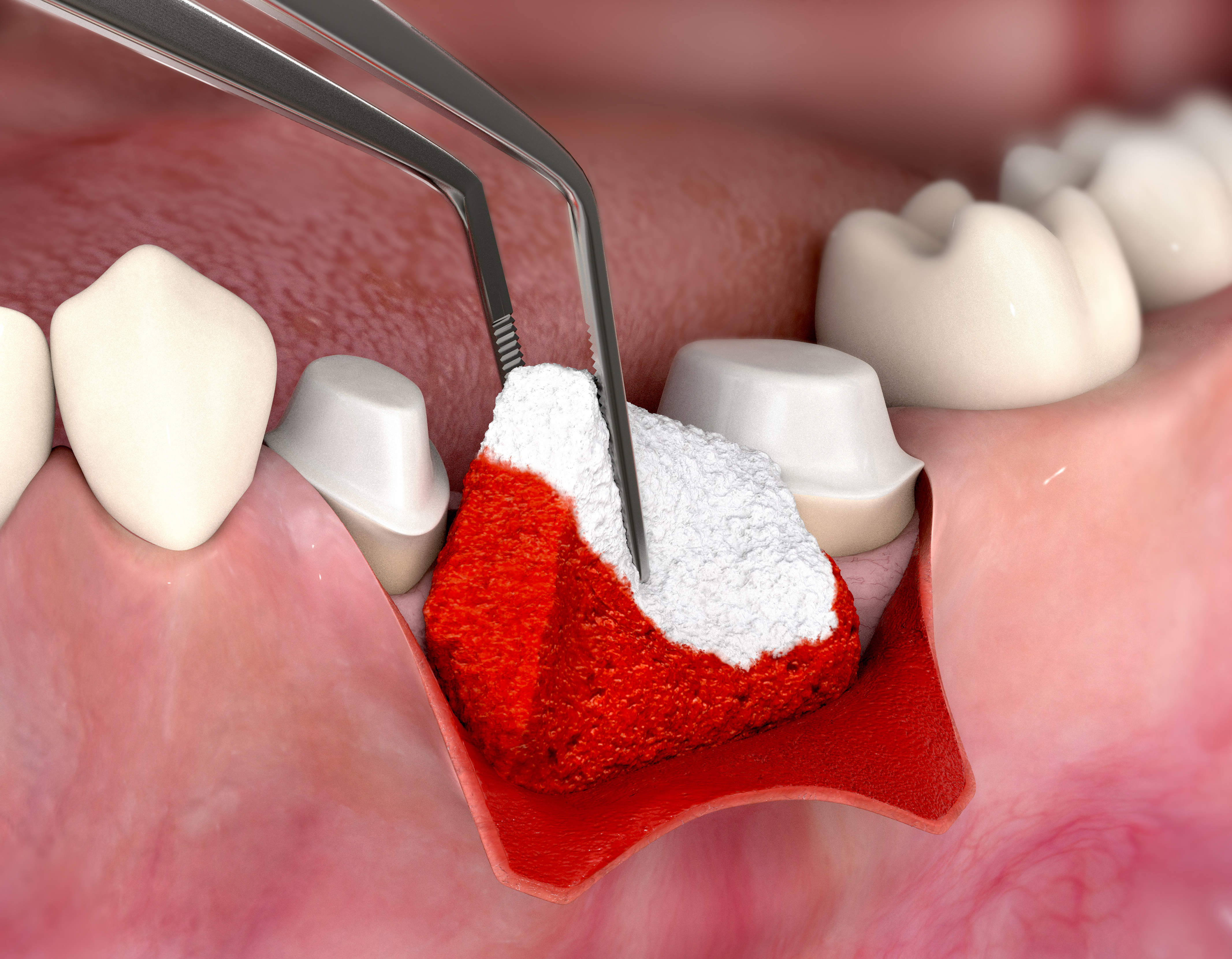 Inserting a biomaterial during soft tissue surgery.