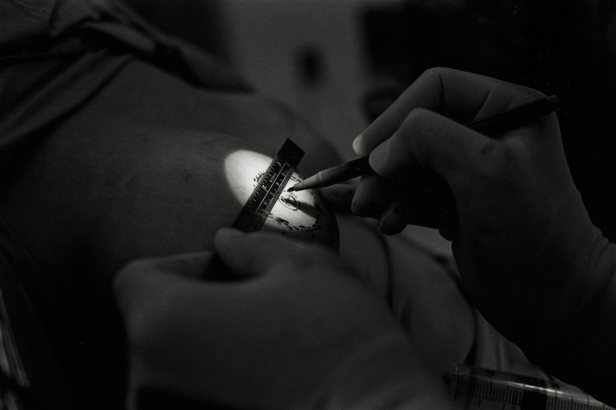 As she nears the end of reconstruction, Diane brings her surgeon an image of how she would like her finished breasts to appear. He explains what he can and cannot do.