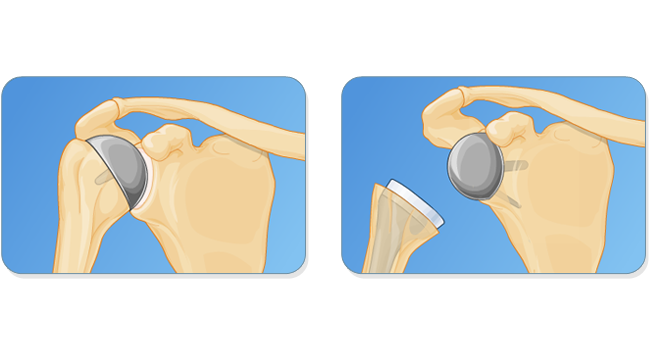 Alternatives to traditional shoulder replacement