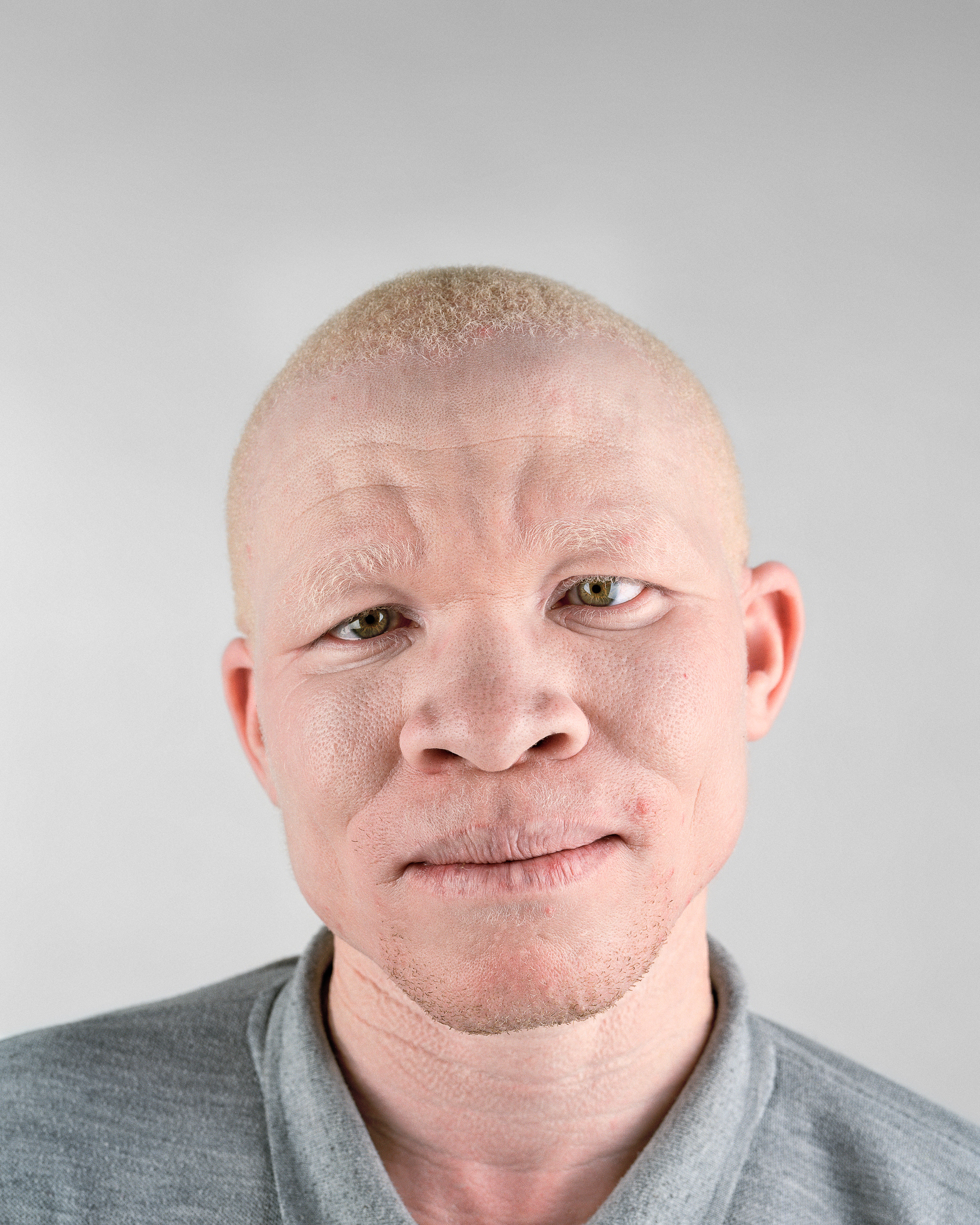 Белый негр. Арнольд Шапиро. Афроамериканец альбинос. Альбинос негроидной расы.