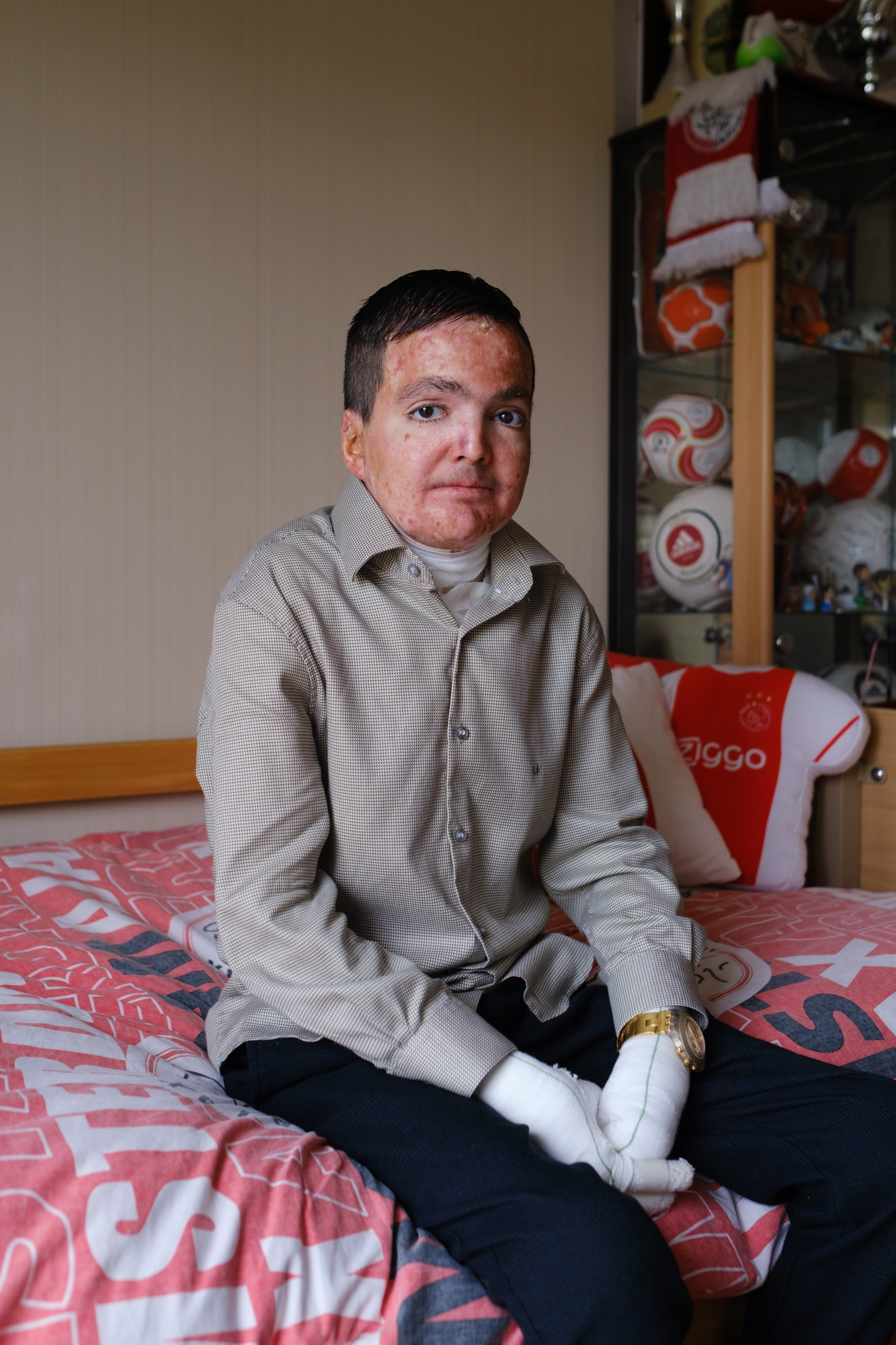 De Volkskrant - Shivan Hassan en zijn ernstige huidziekte