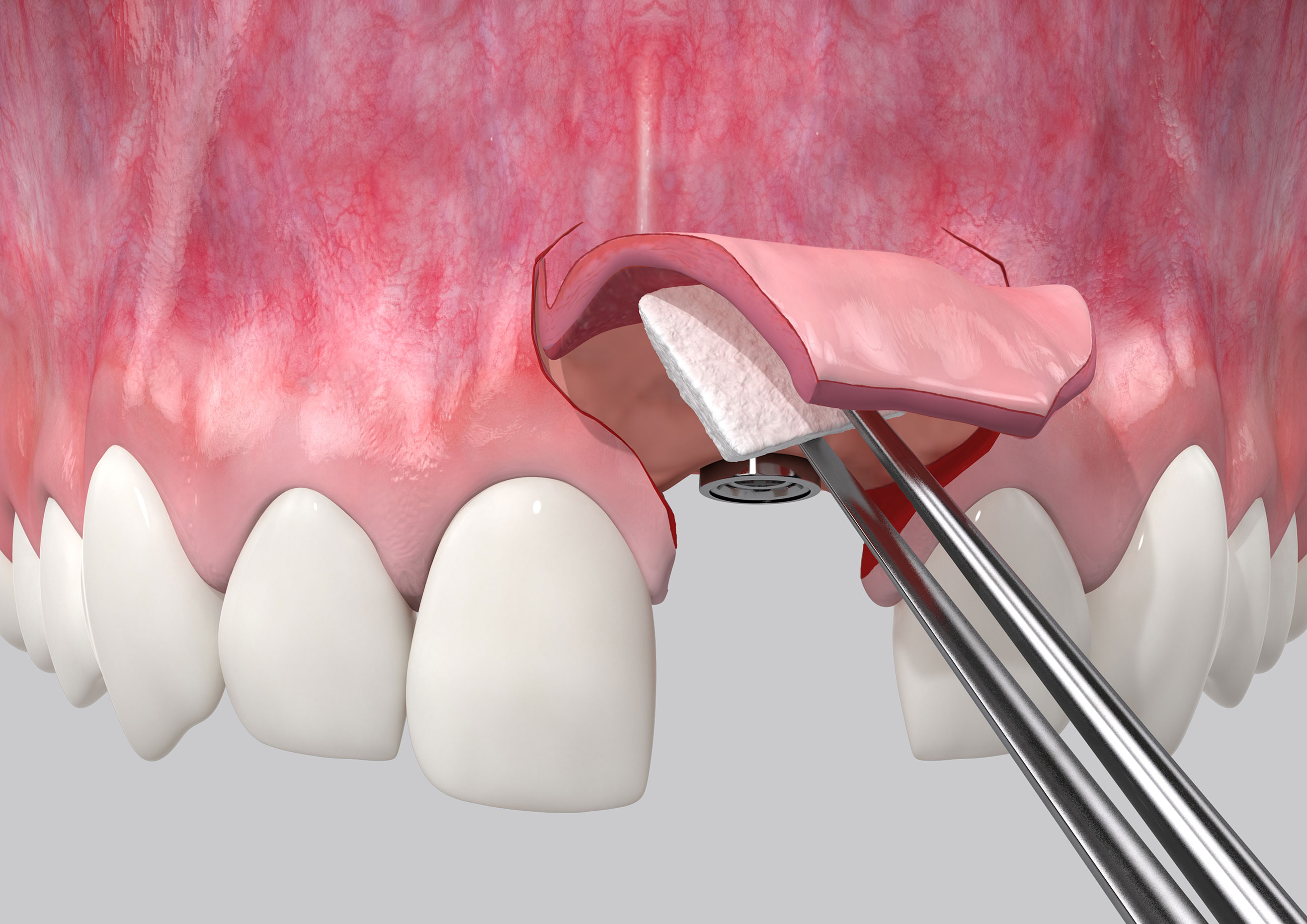 6. Buccal, inserting biomaterial under flap