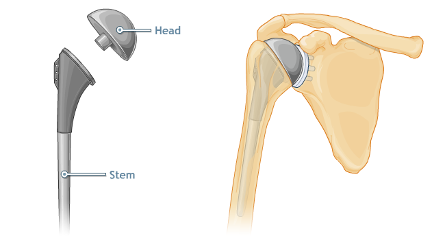 Shoulder replacement parts