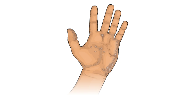Skin changes from arsenic exposure