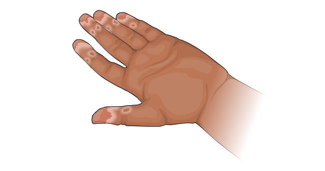 Child's peeling fingertips from toxic exposure