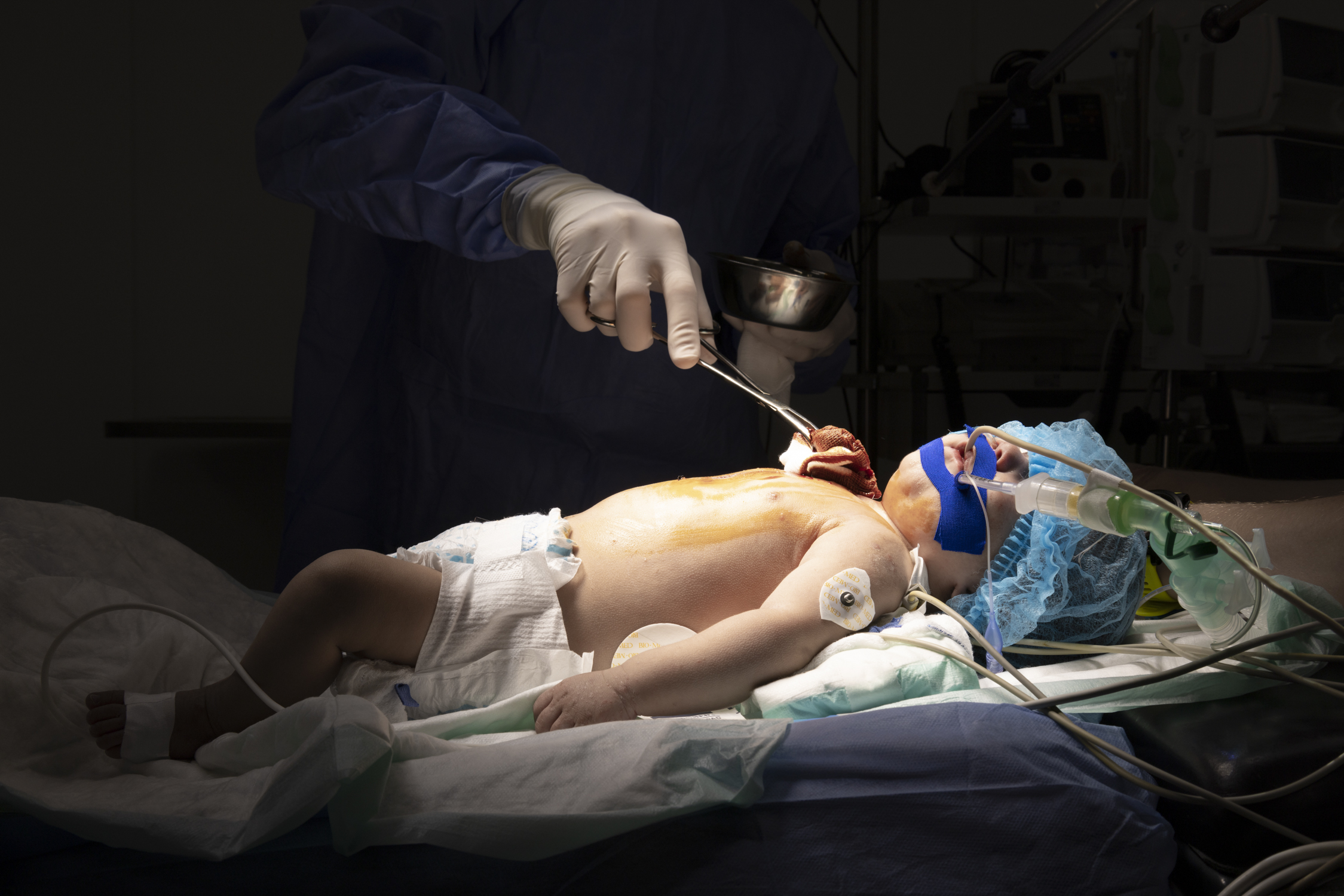 A surgeon applies Betadine on 3-month-old Sanad before surgery. This tan liquid is a common surgical practice to help reduce bacteria on and around skin incision sites.