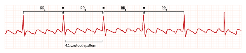 Atrial flutter